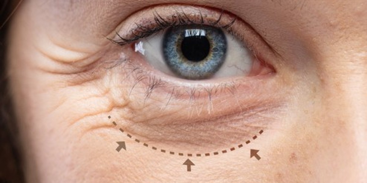 How Long Do Blepharoplasty Dubai Results Last