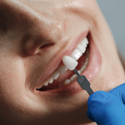 Dental Veneers in Islamabad, Pakistan | Cost & Results